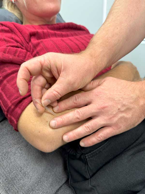 Dry Needling at ARC Physiotherapy