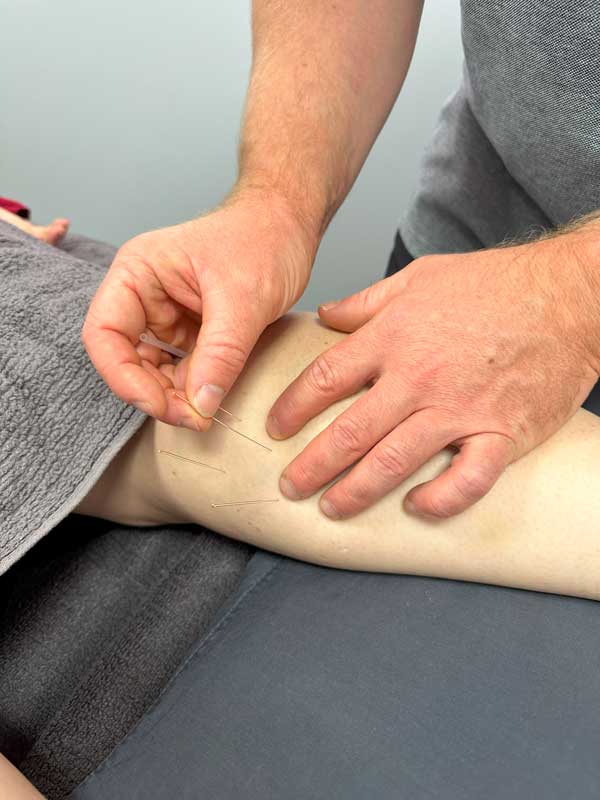 Dry Needling at ARC Physiotherapy